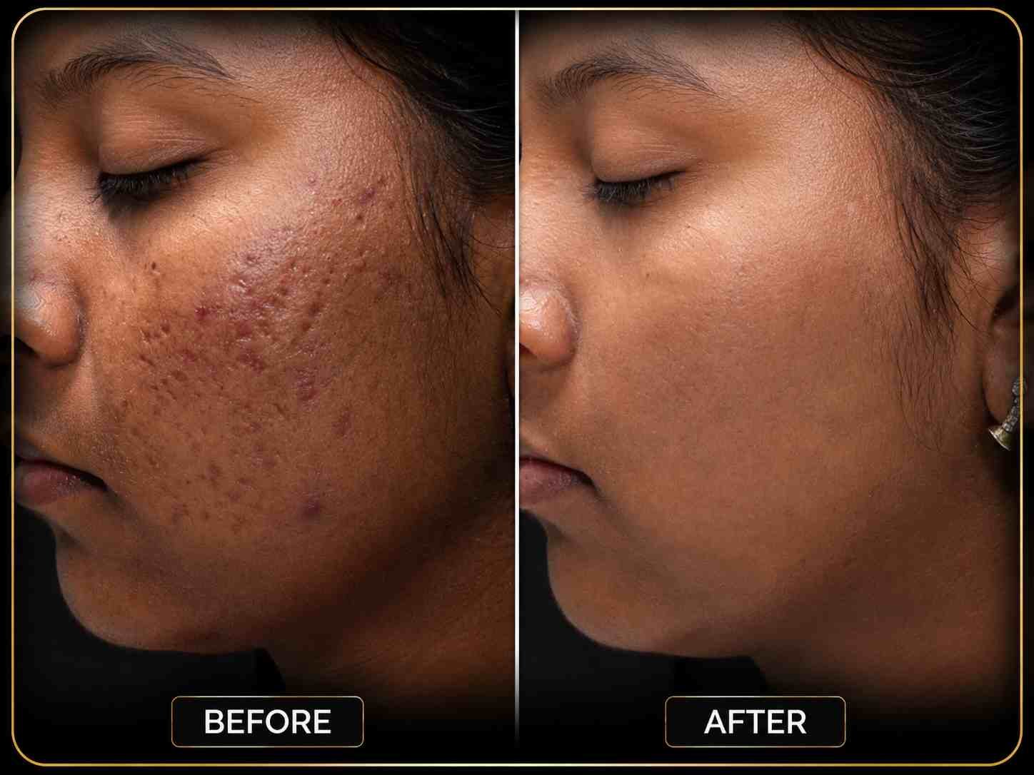 Acne Scar Treatment - After 4 Months